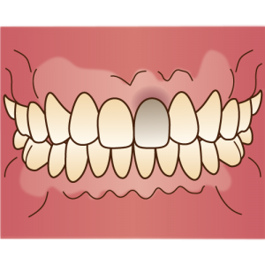 一本だけ歯の色が違う場合の治療法 なな歯科クリニック
